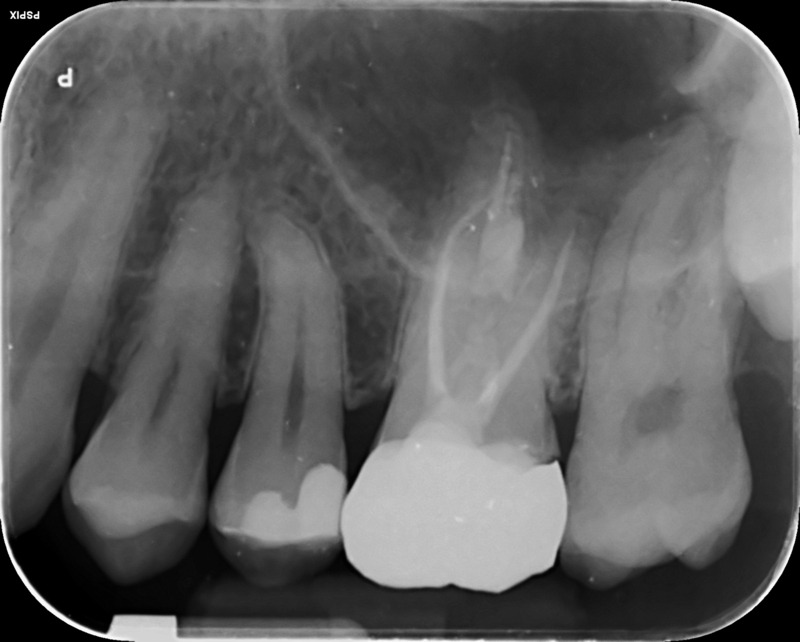 UL6 internal inflammatory resorption case image 5